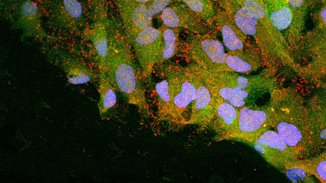 cervical cancer metastasis