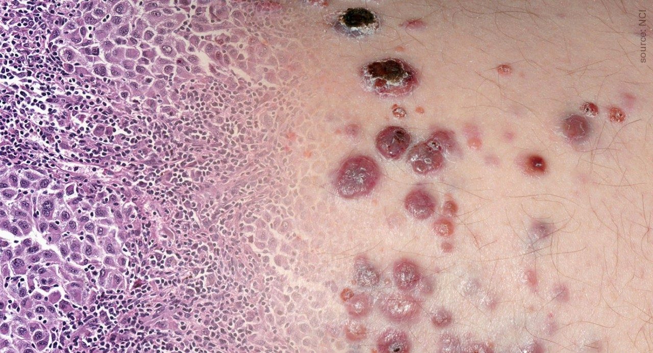 Metastatic melanoma cells