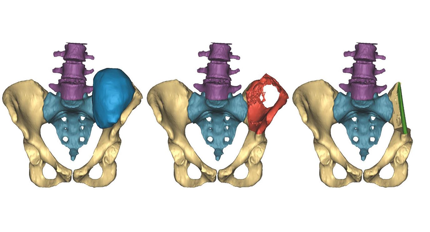 A 3D image shows the initial tumor in blue, left, the surgical plan in red, and then the reconstruction with a fibula implant in green at right. Image by Materialise.