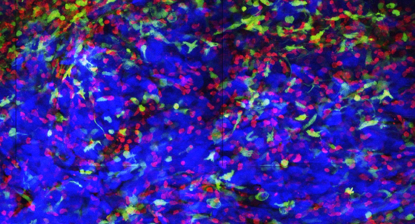 Immune cells attack glioblastoma