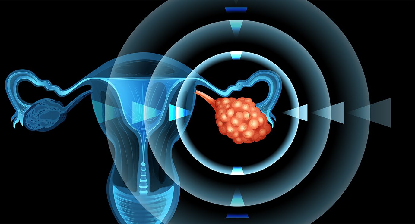 Ovarian cancer 
