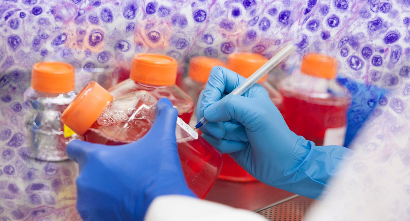 B-cell Lymphoma Trials