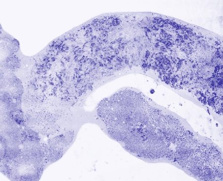 Fluorescence confocal digital microscopy pseudo-colored image of core needle biopsy of liver with metastatic adenocarcinoma 