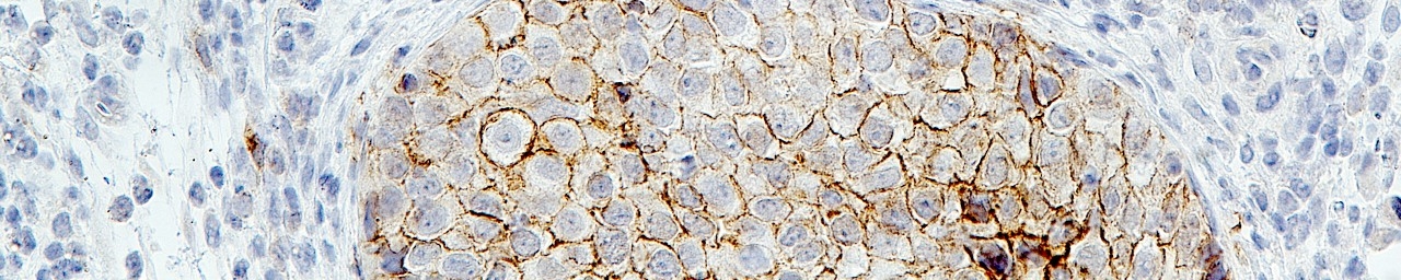 SUM149 shERK1 lung metastasis with E-cadherin IHC