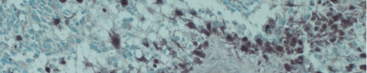 Glioblastoma cells viewed through a microscope in the McCarty Lab