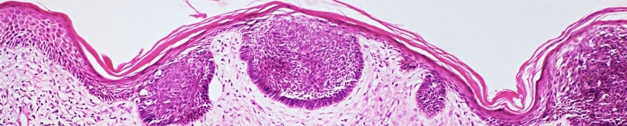 Skin cancer region